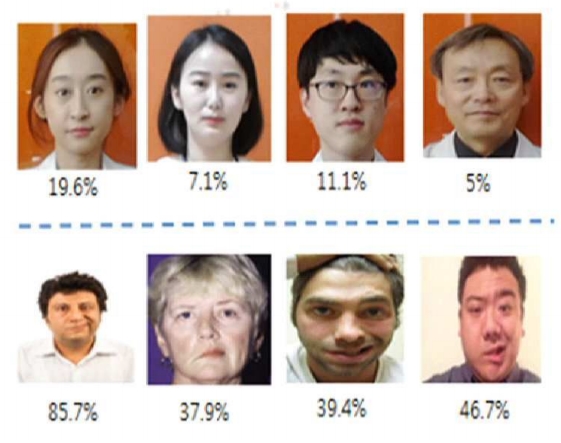 해당 발명의 실시예에 따라 생성된 개인얼굴 특징점세트에 기초해 검출된 뺨주름선 및 일반적인 얼굴 특징점 세트에 기초해 검출된 뺨 주름선을 도시하는 도면. 그림=키프리스