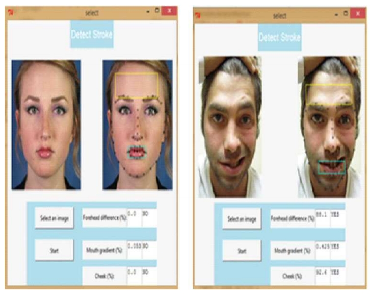 해당 발명의 실시예에 따른 뇌졸중 판단정보 도출부의 동작에 따른 뇌졸중 판단정보가 제공된 화면의 일 예를 개략적으로 도시한 도면. 그림=키프리스