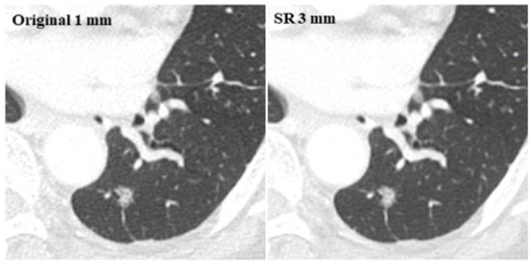 뷰노의 초해상도 알고리즘으로 변환한 CT 영상 이미지(1㎜ 두께로 촬영된 원본 영상(좌)과 3㎜ 두께 영상을 1mm로 변환한 영상(우))의 모습. 사진=뷰노